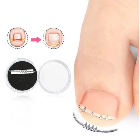 Corrector voor ingegroeide teennagels – afbeelding 2